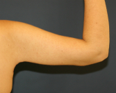 Feel Beautiful - Arm Reduction 33 - After Photo